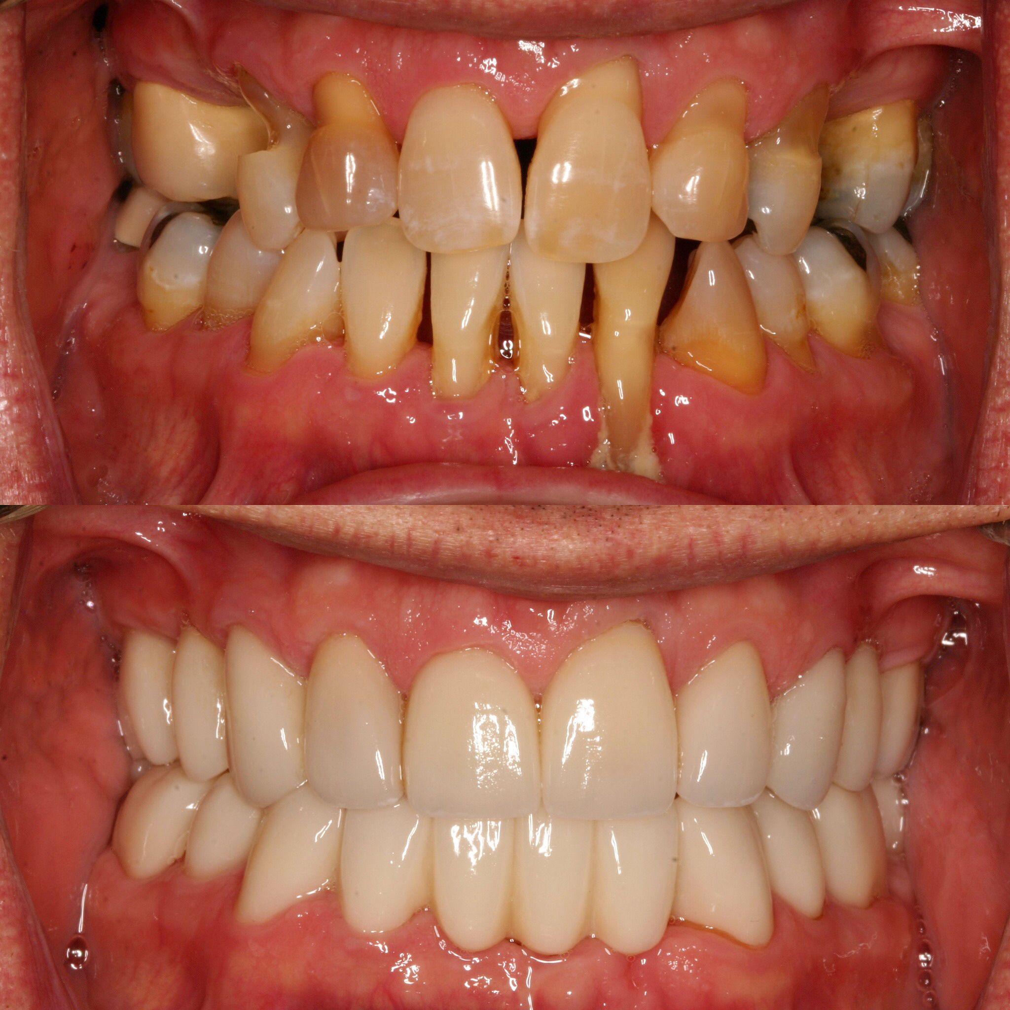 Full Mouth Reconstruction At Aesthetic Dentistry of Palm City in Palm City