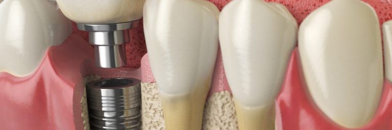 Rendering of Dental Implant