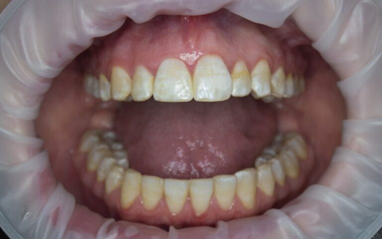 Teeth with signs of brown spot fluorosis