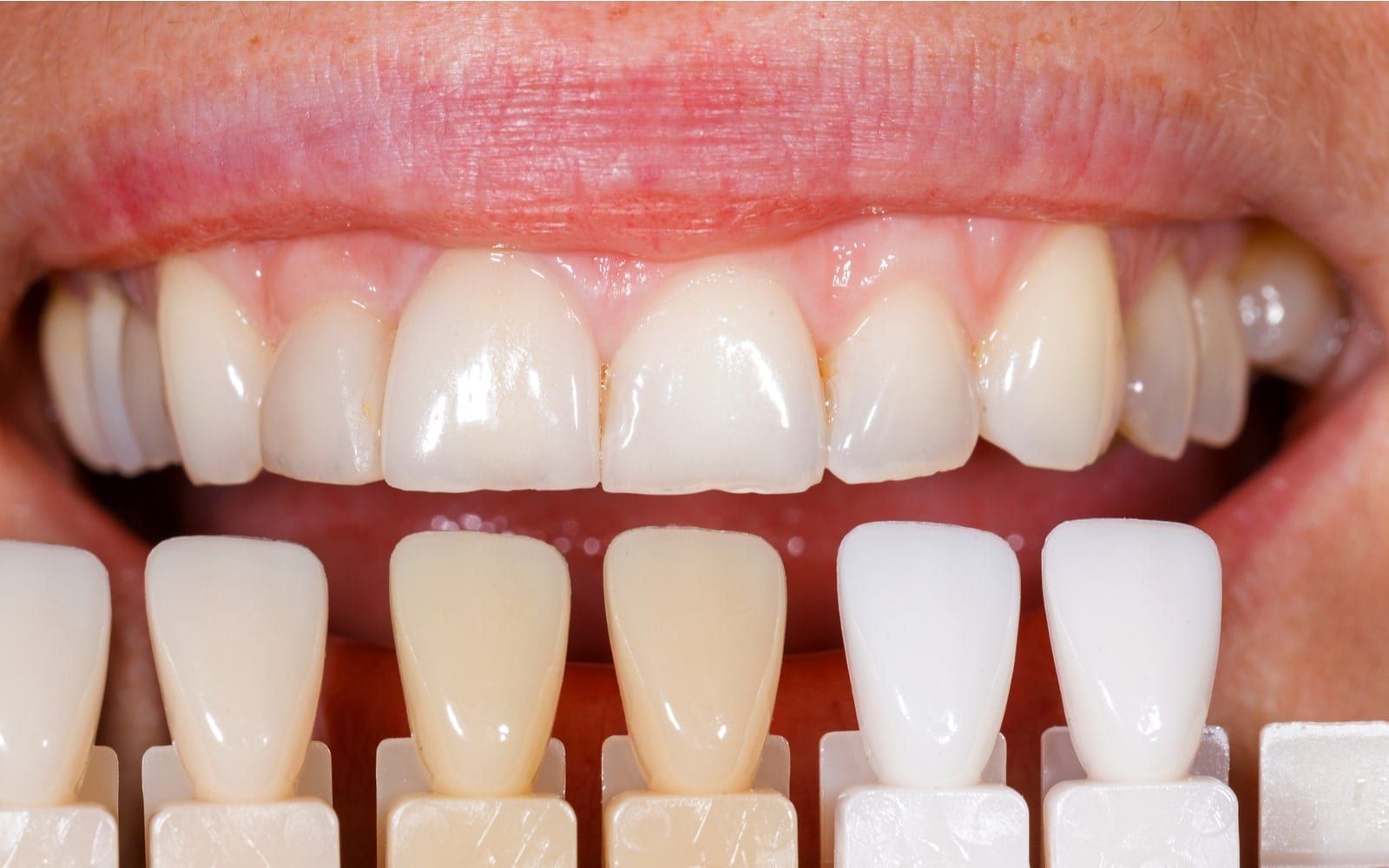 The Dental Art Of Selecting The Right Restoration Shade