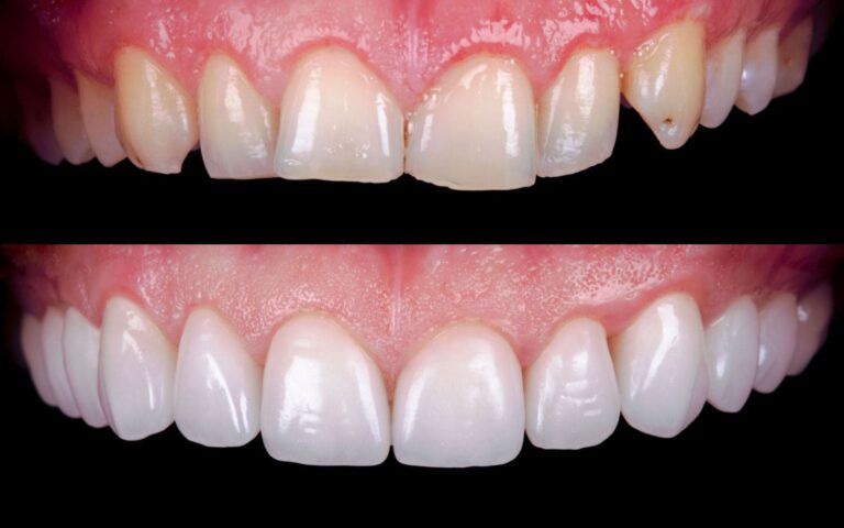 Before and After Photos of Dental Restorations