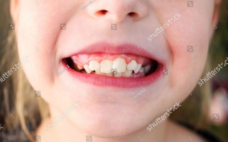 Child Smiling with Crooked Teeth Up Close
