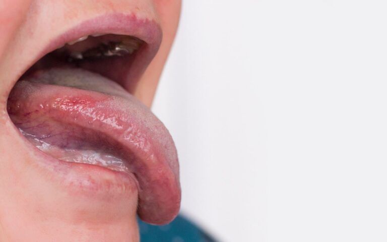Mouth With Oral Lichen Planus Symptoms