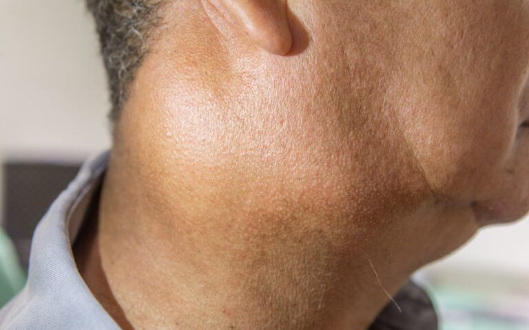 Man with swollen salivary glands