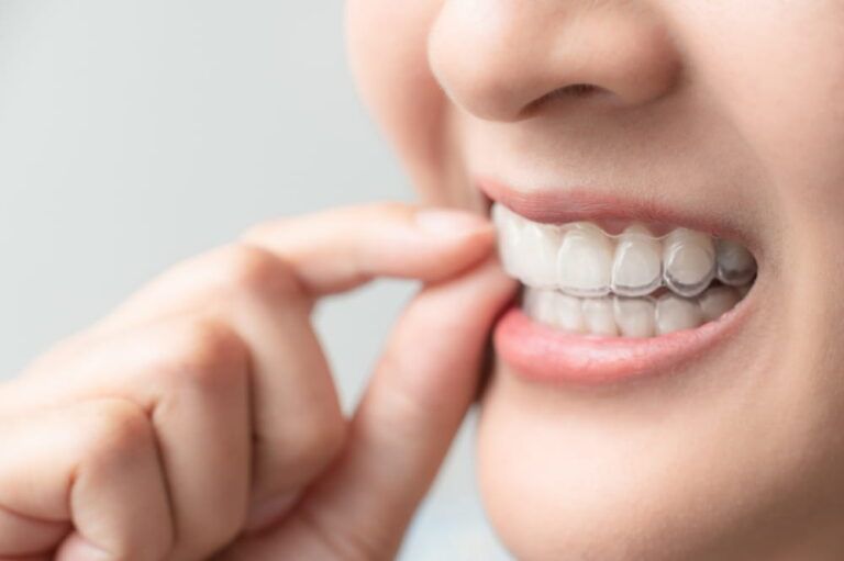 Woman wearing orthodontic silicone trainer. Mobile orthodontic appliance for dental correction. tooth whitening systems.