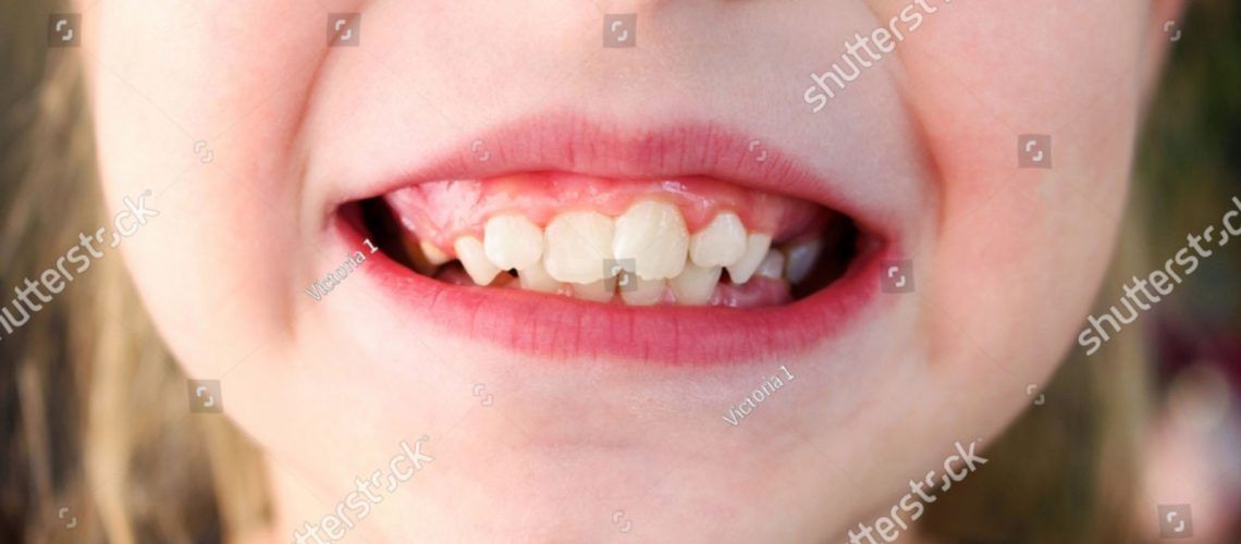 Child Smiling with Crooked Teeth Up Close