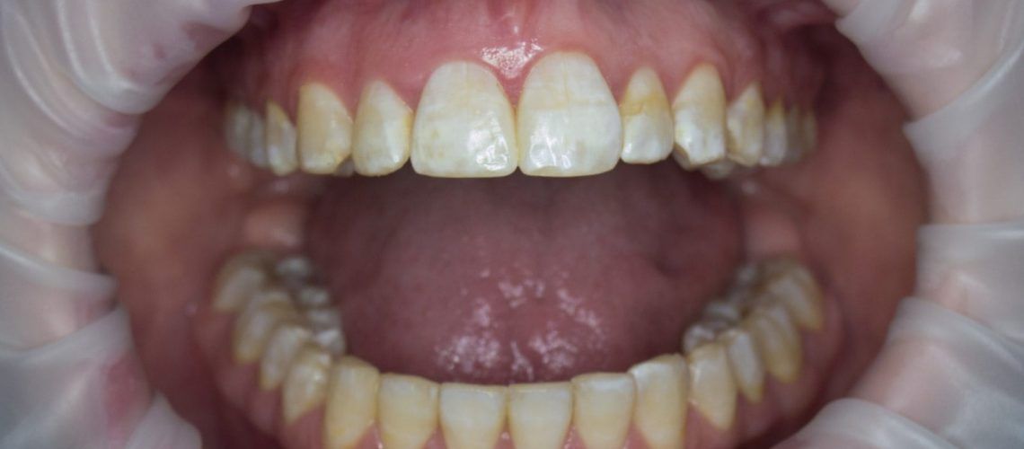 Teeth with signs of brown spot fluorosis