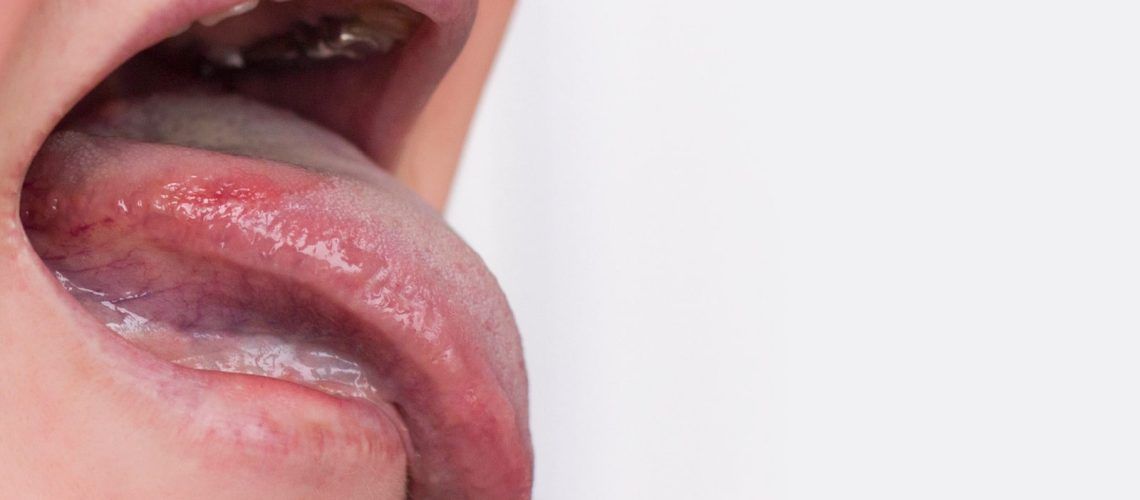 Mouth With Oral Lichen Planus Symptoms