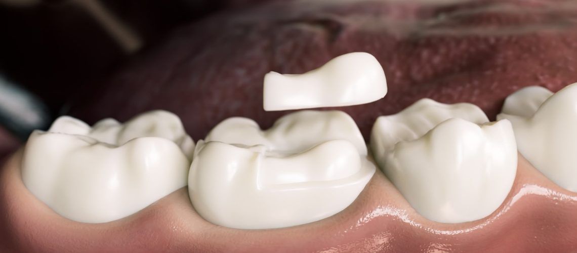 Dental onlay photo of artificial teeth