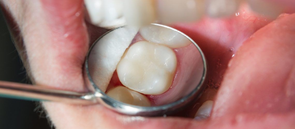 Close-up,Of,A,Human,Rotten,Carious,Tooth,At,The,Treatment