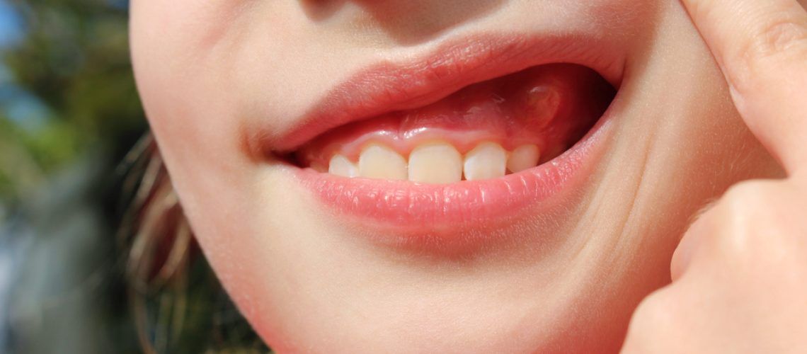 Close,Up,Swelling,On,Gums,The,Child.