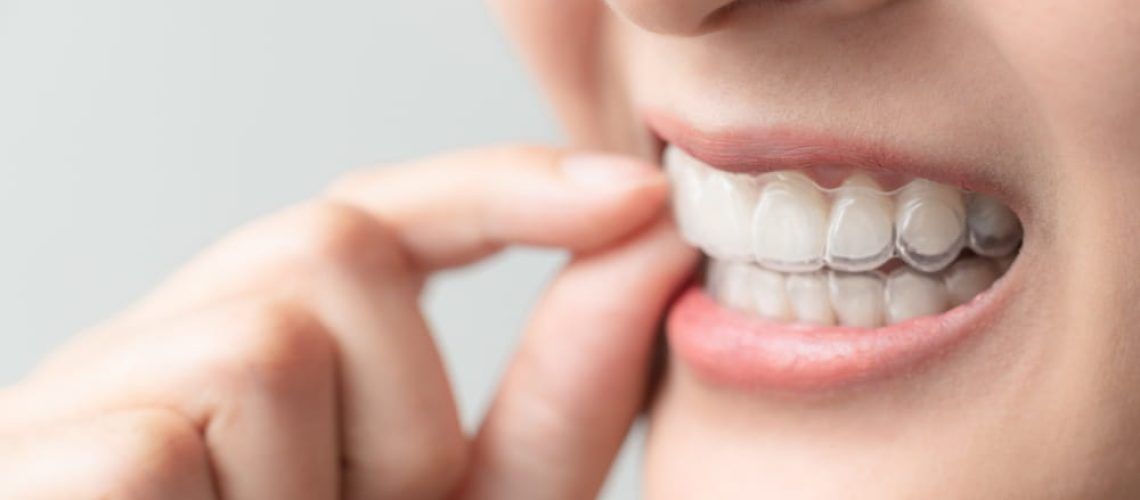 Woman wearing orthodontic silicone trainer. Mobile orthodontic appliance for dental correction. tooth whitening systems.